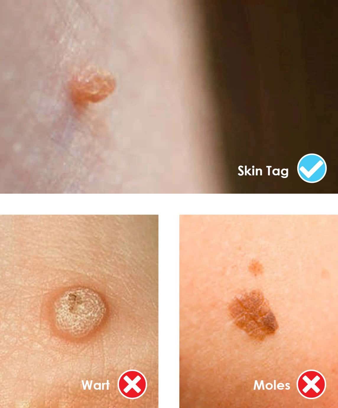 What is a skin tag? Cryotag Clinically Proven Skin Tag Remover